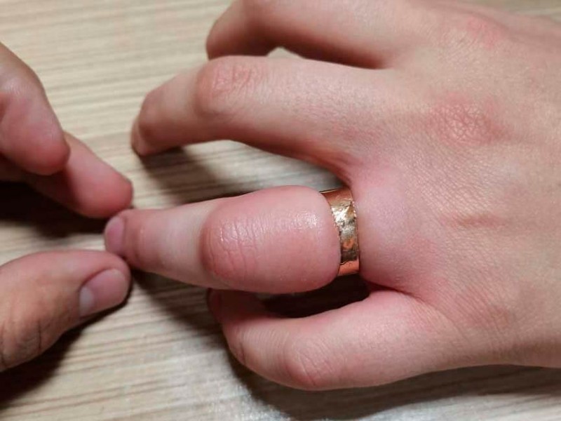 Пришлось резать: Новороссийские спасатели помогли парню снять кольцо с распухшего пальца